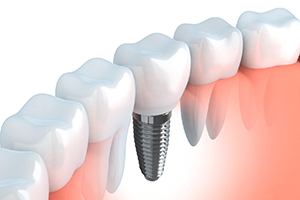 Diagram of an integrated dental implant in Lewisville