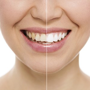 Smile split in half showing before and after whitening