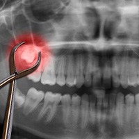 An X-ray of a wisdom tooth