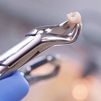 An extracted wisdom tooth in a forceps.