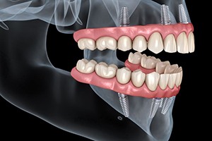 Illustration of All-on-4 for upper and lower dental arches