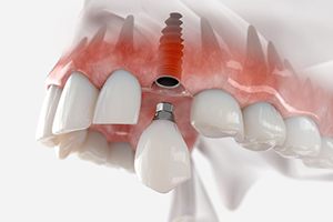 Illustration of single dental implant between natural teeth
