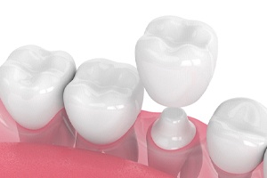 Diagram showing how dental crowns in Lewisville work