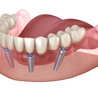 Implant dentures in Lewisville on white background   