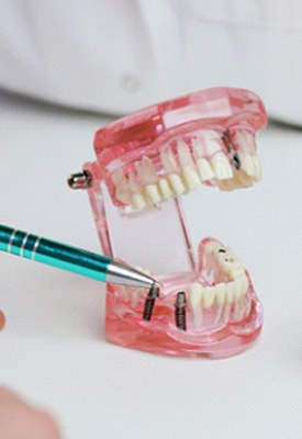 Dentist’s hands pointing to sample implant bridge with green pen