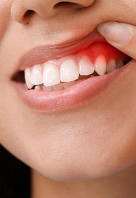Nose-to-chin view of woman pulling back upper lip to reveal dark swollen gums