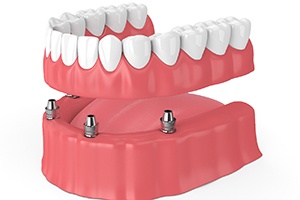 Illustration of implant dentures in Lewisville, TX