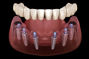 Illustration of full implant dentures in Lewisville, TX for lower arch
