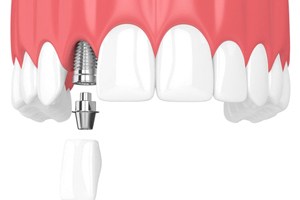 Diagram highlighting how dental implants works in Lewisville