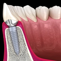 Diagram showing how dental implants work in Lewisville