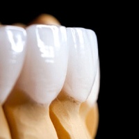 Restorations for dental implants in Lewisville attached to model