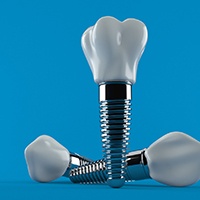 Diagram of dental implants in Lewisville