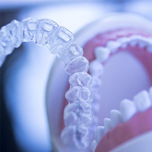 Invisalign and false teeth