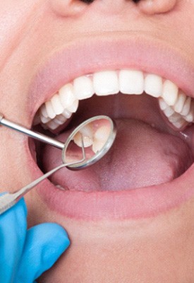 Closeup of woman’s mouth being examined with dental mirror and pick