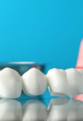 Dental bridge in front of dental implant on reflective surface with light blue background