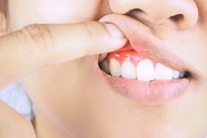 Woman lifting lip to show inflamed gum tissue