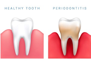 Illustration showing healthy tooth vs. periodontitis