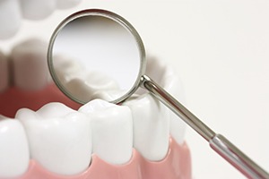 Dental sealant treated teeth enlarged with mirror