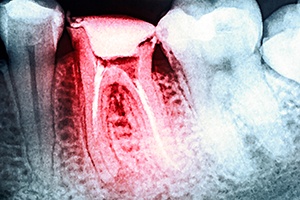 X-ray image of dental crown treated tooth