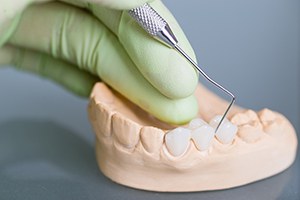 Model of smile with fixed bridge