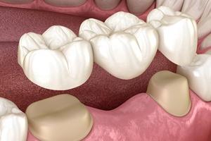 Diagram showing a dental bridge in Lewisville