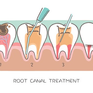 woman toothache in bed for root canal therapy in Lewisville