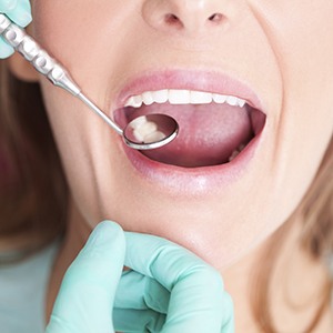 lady getting a tooth colored filling