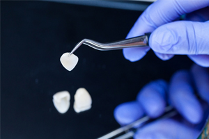 Dental lab creating veneers in Lewisville.