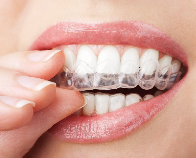 an Invisalign aligner in a person’s mouth