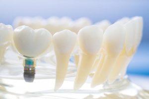 model of dental implant