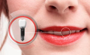 Close up of dental implant post and crown