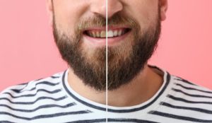 a man showing his smile before and after his cosmetic dental work