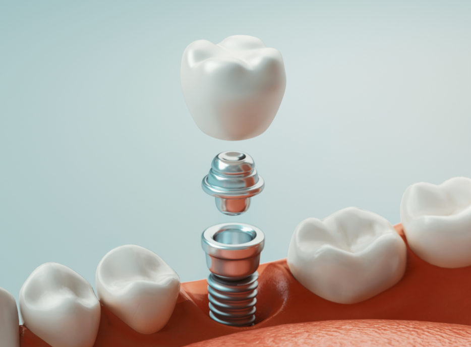 3D image of a dental implant